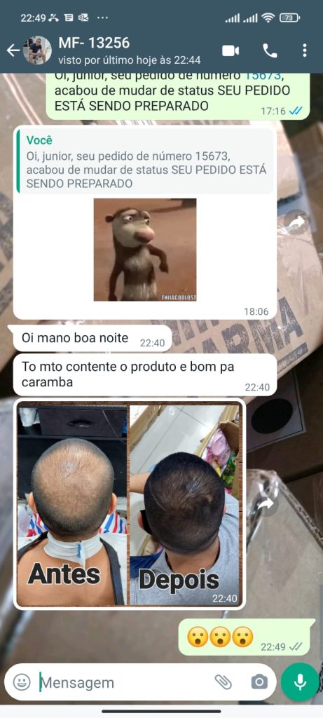 antes e depois minoxidil  Pedro Lima