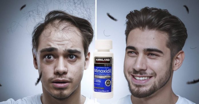Minoxidil efeito shedding