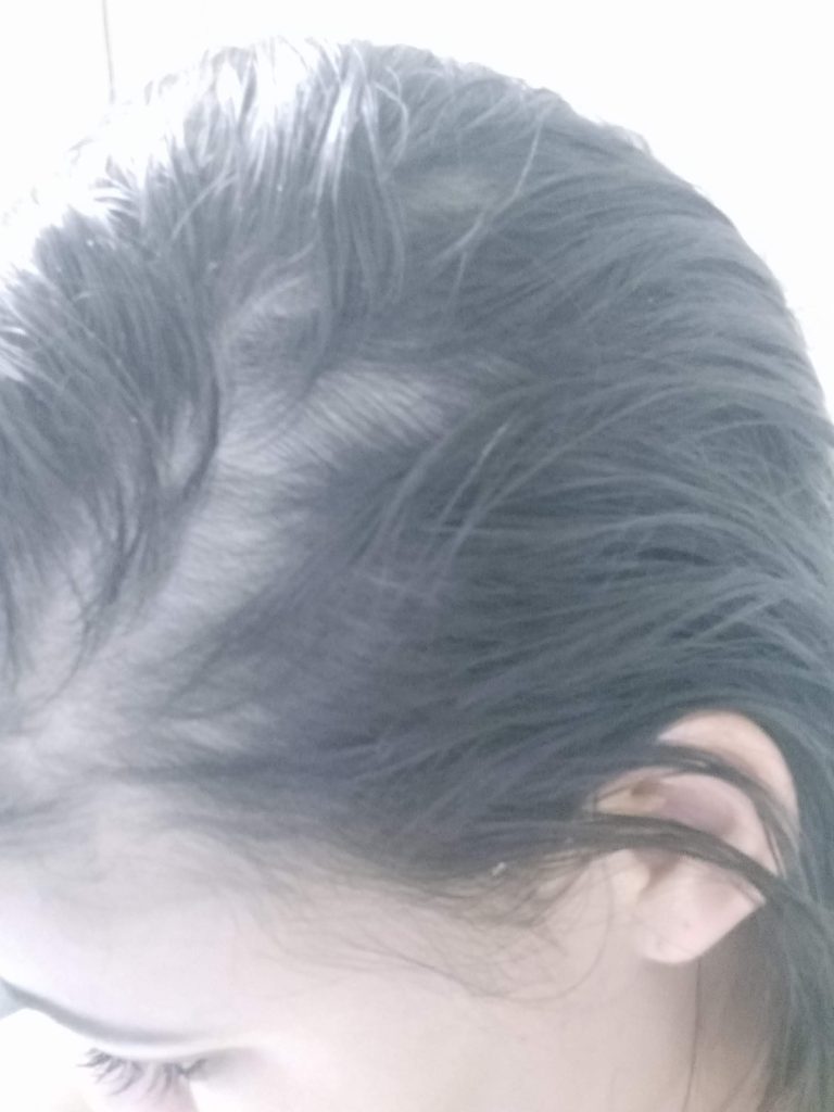 evolução cabelo de mulher com minoxidil