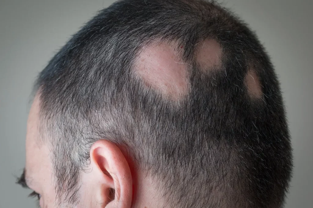 Alopecia por estresse